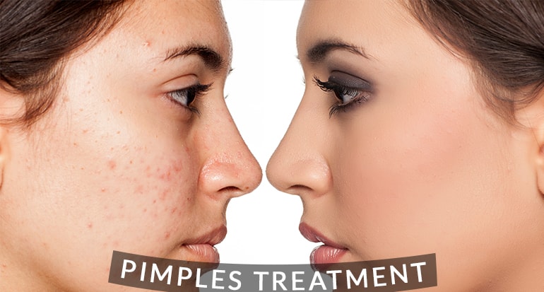 Acne Treatment in Jayanagar