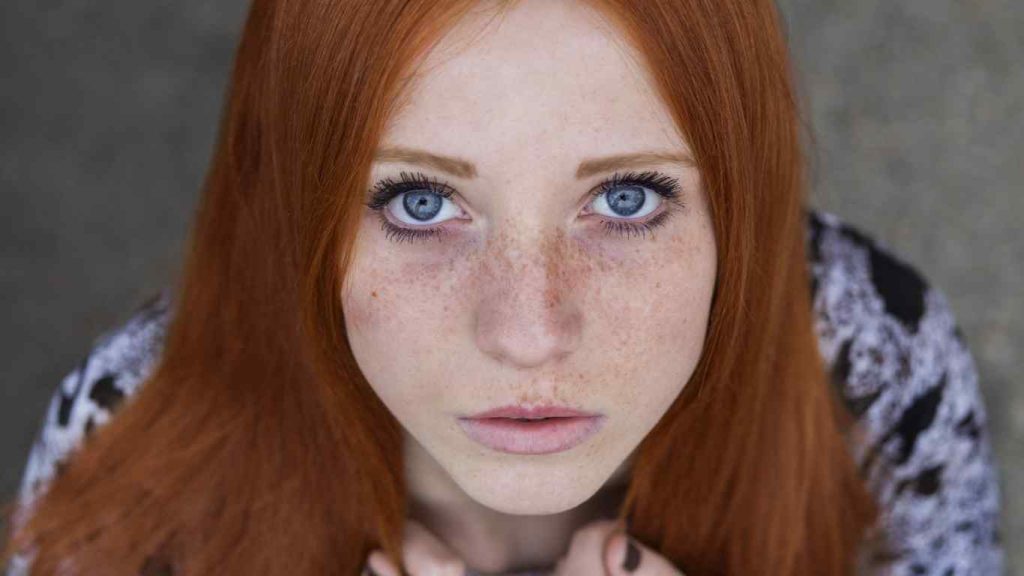 freckle