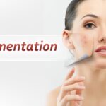 pigmentation