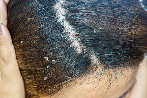 closeup hair with dandruff scalp,Seborrheic Dermatitis