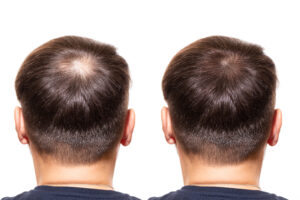 best hair loss treatment in bangalore